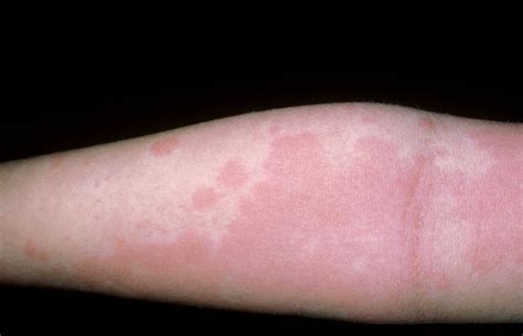 Allergic Reaction Rash On Arms