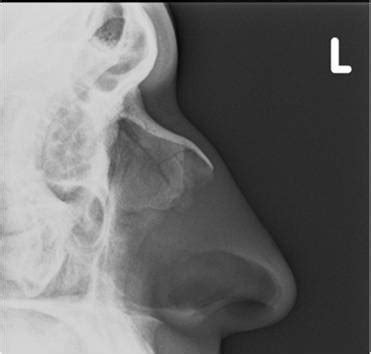 Nasal Bone Fracture- Grey Zone - Sumer's Radiology Blog