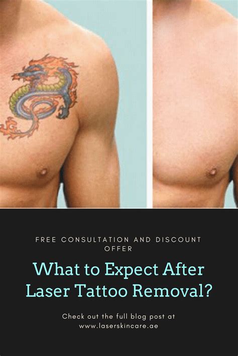 What to Expect After Laser Tattoo Removal? - Laser Skin Care