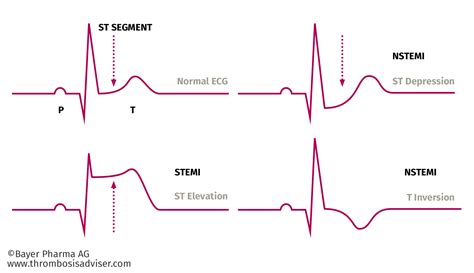 Pin by Mel De Leon on Medicine | Nurse tutor, Cardiac nursing, Nursing ...