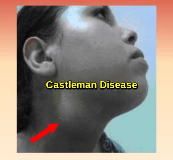 Castleman Disease - Ask Hematologist | Understand Hematology