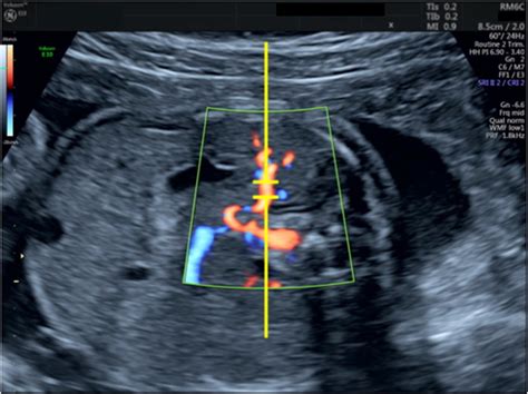 Ultrasound image of the splenic artery including the Doppler gate for... | Download Scientific ...