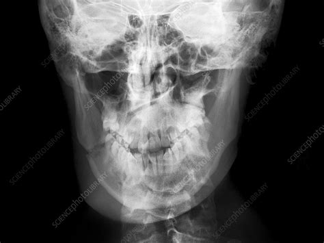 Broken jaw, X-ray - Stock Image - C017/7558 - Science Photo Library