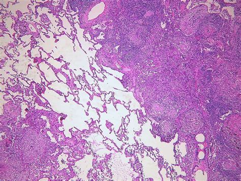 Central Caseation Necrosis – Nursing Lecture