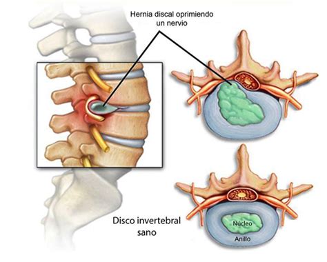 Hernia discal lumbar y tratamiento quiropráctico - Ana Quiropractica ...