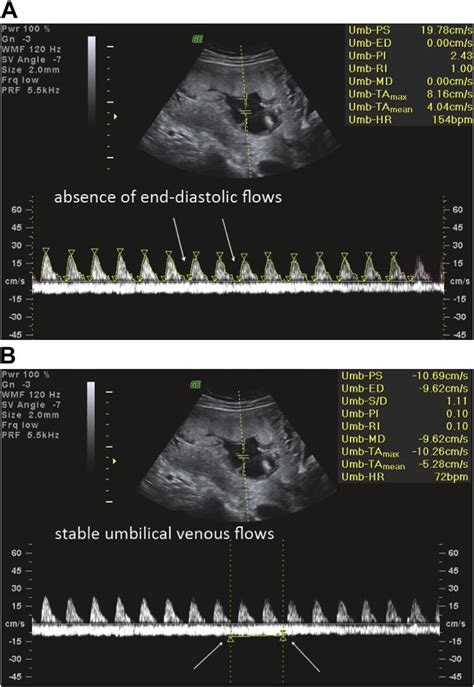 (A) Doppler ultrasound waveforms of umbilical arterial flows in one of... | Download Scientific ...