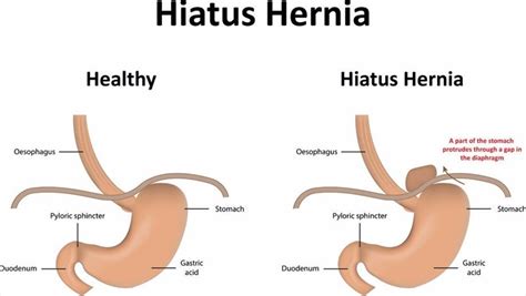 Signs and symptoms of hernia