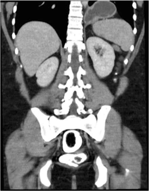 Computer tomography of the abdomen preoperatively. The gastric remnant... | Download Scientific ...