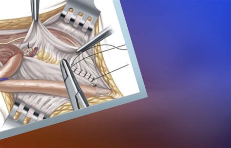 Laparoscopc Inguinal Hernia Repair | Saudi German Health