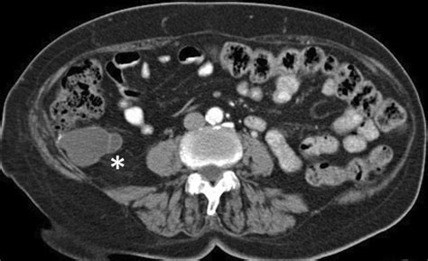 CT scan showing low-grade appendiceal mucinous neoplasms with liquid... | Download Scientific ...