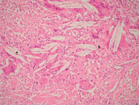 Tendinous Xanthoma Histology