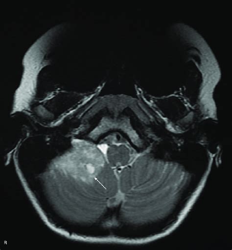 Cerebellar dysplastic gangliocytoma (Lhermitte-Duclos disease) (arrow ...