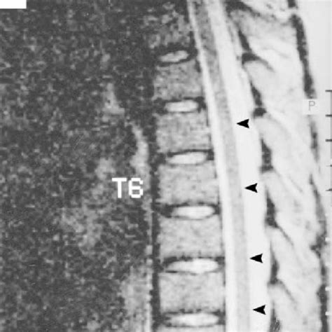 Specimen from a Sural-Nerve Biopsy Showing Axonal Degeneration with ...