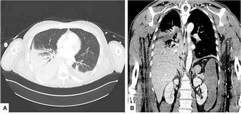 Preoperative CT scan. (A) Axial and (B) coronal views of admission ...