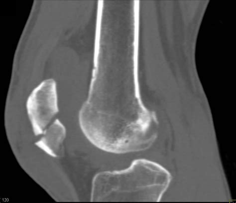 Patella Fracture - Musculoskeletal Case Studies - CTisus CT Scanning