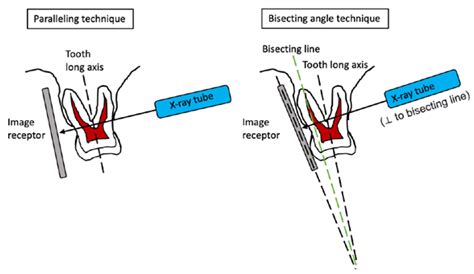 The Performance of Paralleling Technique and Bisecting Angle Technique ...