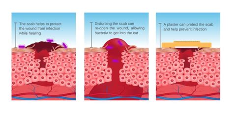 Graze Wound - Pictures Of The Wound Healing Process - Minor wounds ...