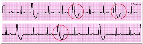 Recognizing ECG Irregularities | Favoriteplus.com Blog