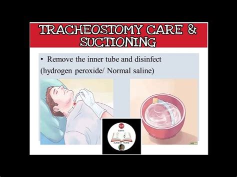 Tracheostomy care-Steps/procedure,suctioning-Tracheal/ ET/Oral,Home care/ Nurses management ...