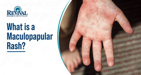 Maculopapular rash: Causes and Treatment