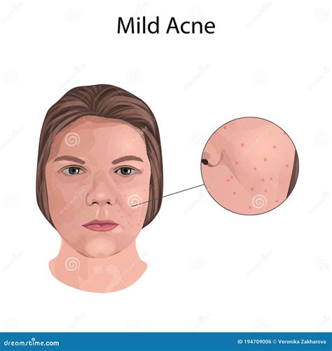 Mild Acne. Young Woman Face with Skin Inflammation. Close-up View ...