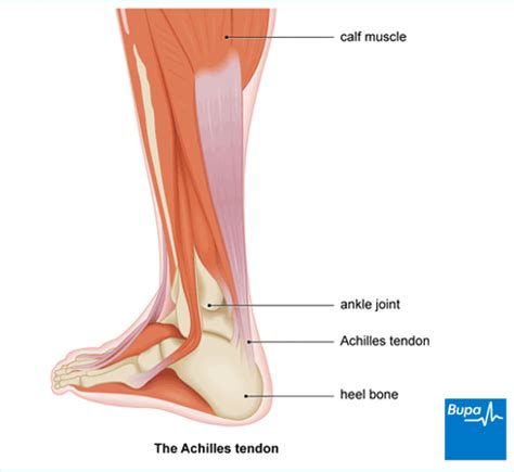 Achilles tendinopathy | Treatment and Symptoms | Bupa UK