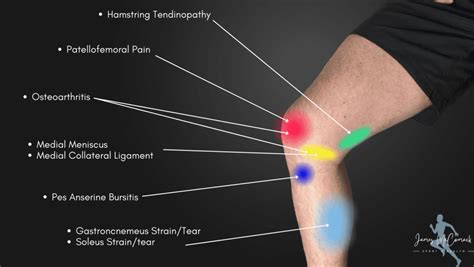 Knee Pain Location Chart | Learn the Pain Location of Knee Injuries