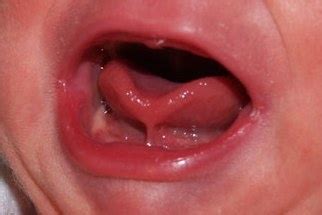 Posterior tongue tie symptoms. | Midwifery | Pinterest