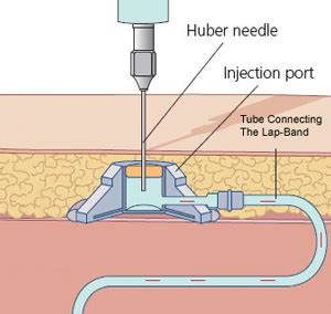 What is a Lap-Band Adjustment (Fill) and How is it Done?