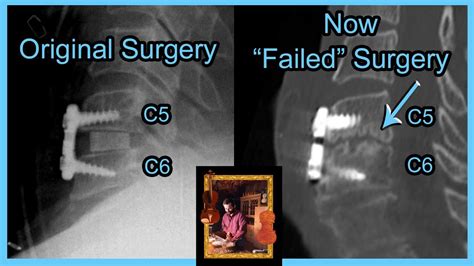 Failed Spine Surgery = ACDF Surgery Again! C5-C6-C7 fusion and recovery by a Violin Maker - YouTube