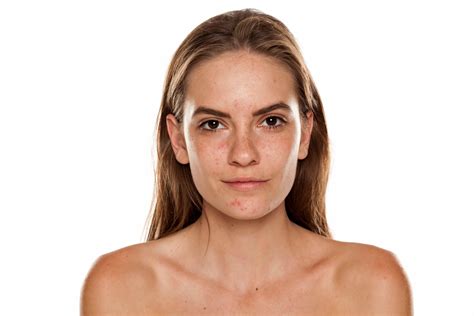 Was ist Rosacea? Rote, entzündete und gereizte Haut