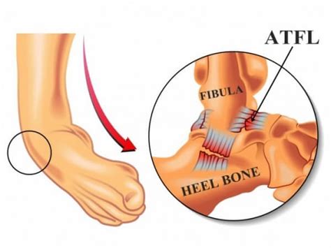 ATFL Injury - Ankle Sprain | Dr. Sai Krishna B Naidu