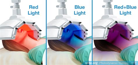 Does Photodynamic Therapy Work for Acne? - Acne.org