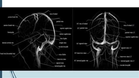 Dural venous sinus thrombosis for Radiology & Imaging