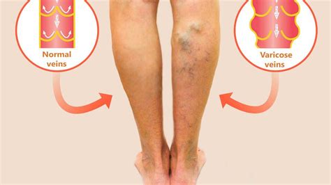 Varicose Veins Treatment and Surgical Procedure Options