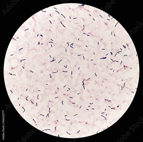 Smear of human blood culture Gram's stained with gram positive bacilli ...