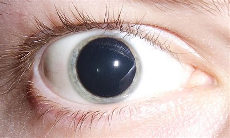 Mydriasis - Wikipedia