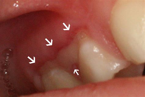 How to Manage a Pediatric Patient with Oral Ulcers | JCDA