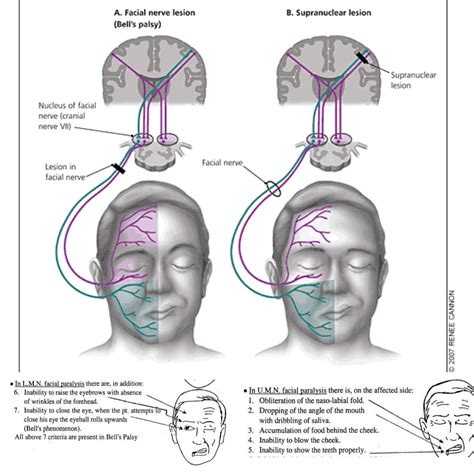 LMN & UMN Facial Nerve Palsy.