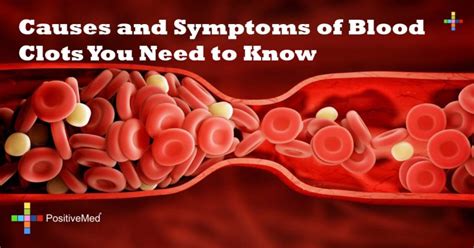 Causes and Symptoms of Blood Clots You Need to Know - PositiveMed