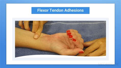 Best Practice for Flexor Tendon Rehabilitation | MedBridge