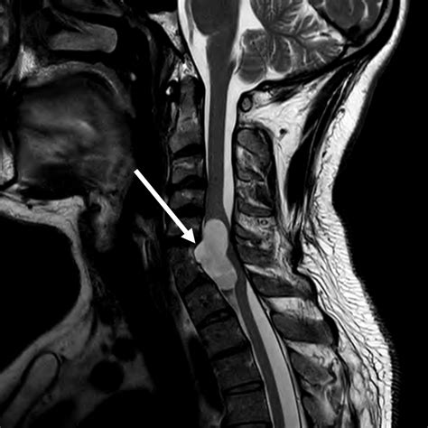 Cureus | Neurenteric Cyst: Case Report and Operative Video