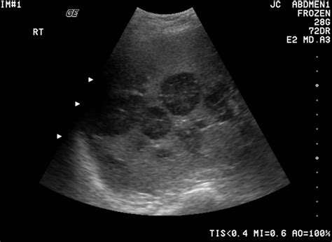 Can Ultrasound Detect Cancer? | New Health Advisor