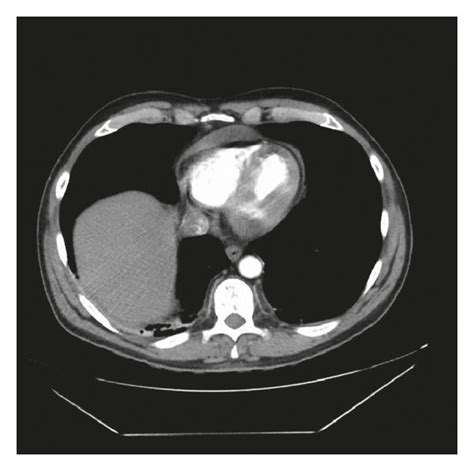 CTA chest with (a) and without (b) contrast enhancement demonstrating... | Download Scientific ...