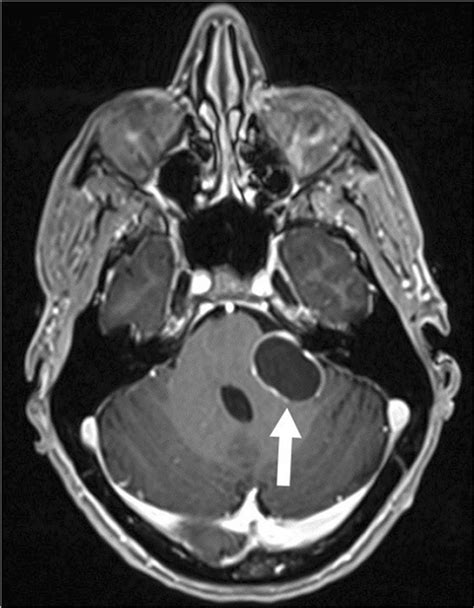 Eleven years after SRS. Axial T1-weighted MRI slightly superior to IAC... | Download Scientific ...