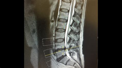 Day 6 after L4/L5 Microdiscectomy Lumbar Back Surgery for Slipped Herniated Disc - YouTube