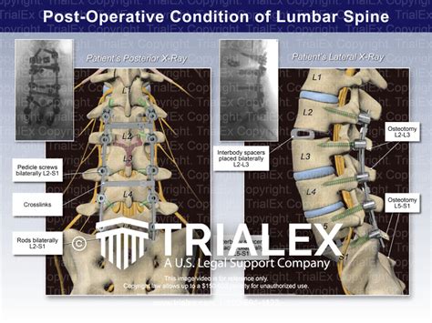 Post-Operative Condition of Lumbar Spine - TrialQuest Inc.