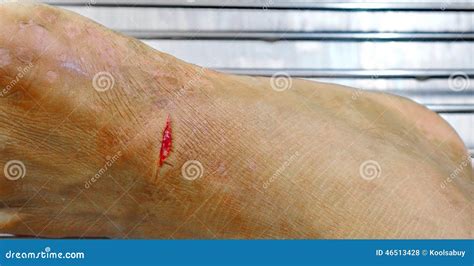 Foot dressing wound. stock photo. Image of treatment - 46513428