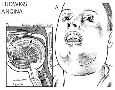 Ludwig's Angina: Ludwig's Angina Therapy Details