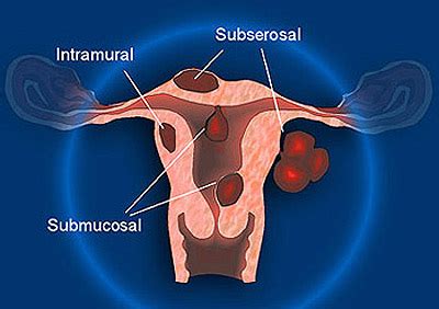 Myoma Uteri - Calamba Medical Center